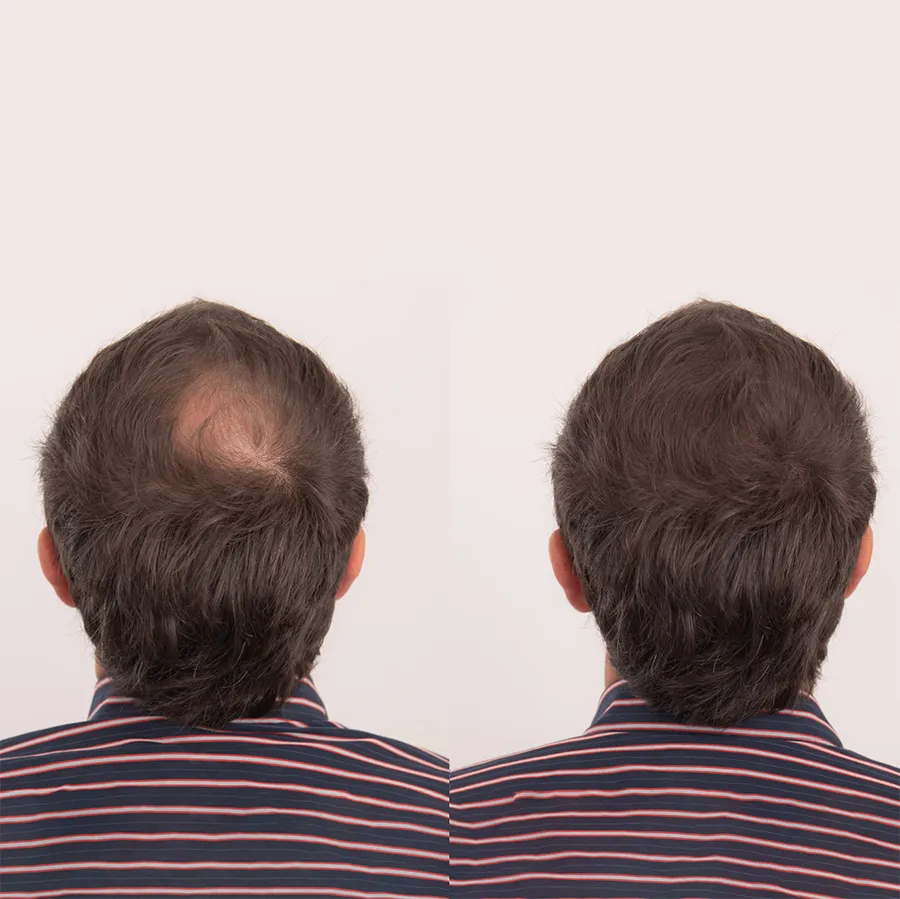 Prije i poslije primjene vlakana za kosu